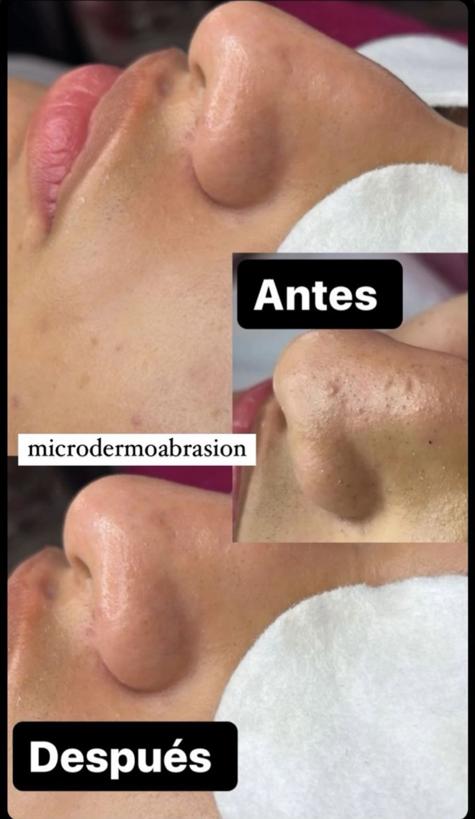 Microdermoabrasión
