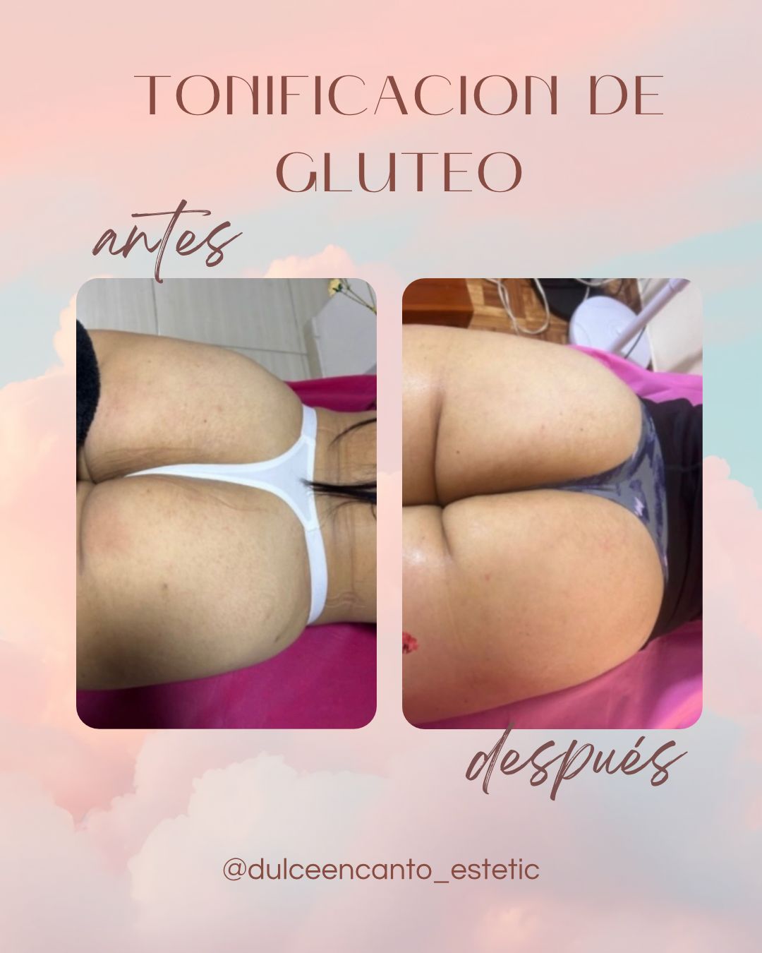 Tonificación glútea